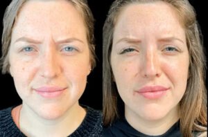 Why Botox Done by the Best Doctors in Dubai Looks Natural