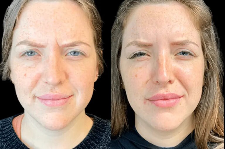 Why Botox Done by the Best Doctors in Dubai Looks Natural