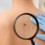Signs That Your Skin Tag Needs Removal