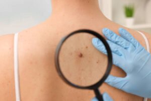 Signs That Your Skin Tag Needs Removal