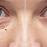Expert Eyelid Surgery for a Fresh, Youthful Appearance