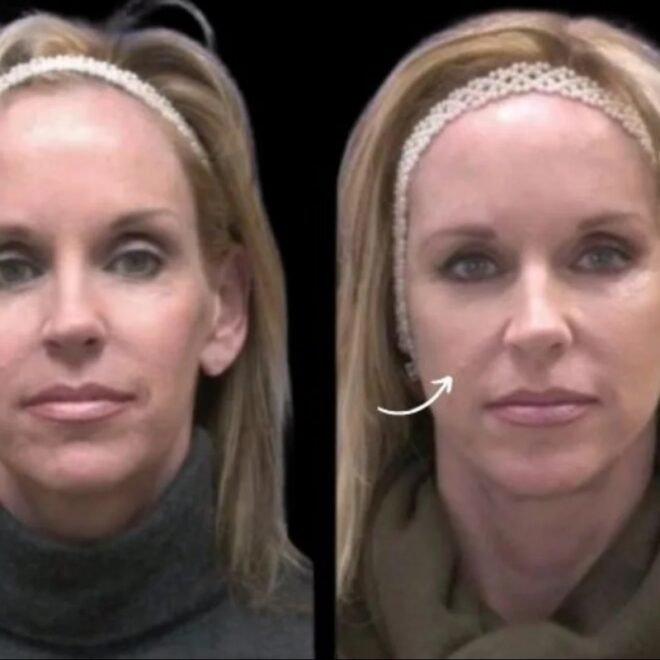 Best Plastic Surgeons in Dubai for Sculptra for Arab Features