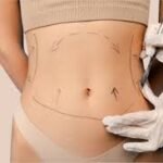VASER Liposuction in Dubai: Precision Fat Removal Technology