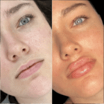 Fillers Treatments in Dubai for Subtle Enhancements