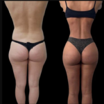 Best Plastic Surgeon in Dubai Discusses Long-Lasting J-Plasma Results