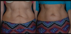 Unlock Youthful Skin at the Best Aesthetic Clinic in Dubai with Skin Tightening