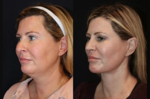 Best Plastic Surgeon in Dubai Discusses the Benefits of Skin Tightening