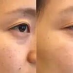 تصبغات البشرة في الرياض: فهم فرط التصبغ والبقع الداكنة