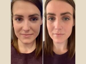 PRP Treatment in Dubai for Modern Hair Care