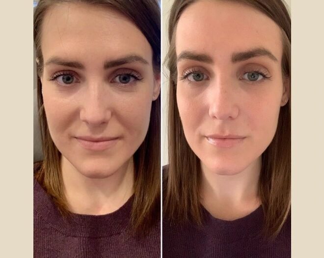 PRP Treatment in Dubai for Modern Hair Care