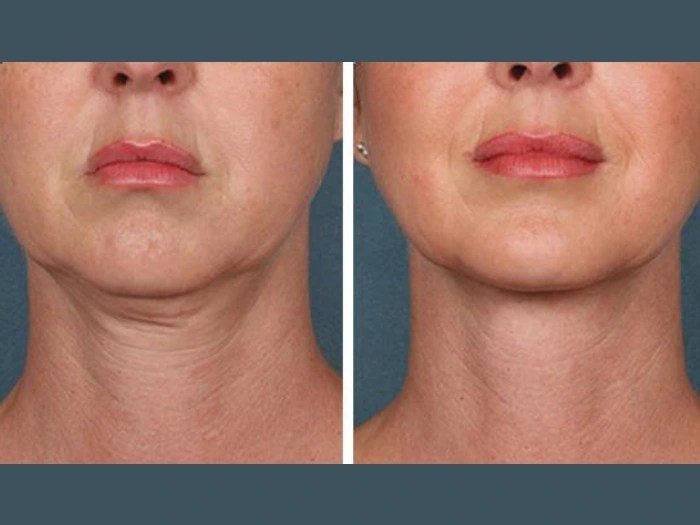 Best Plastic Surgeons in Dubai Explain PRP Treatment Safety