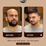 Celebrity Hair Replacement: Trends from the Red Carpet