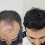 Hair Transplant in Islamabad: Restore Your Hair and Confidence