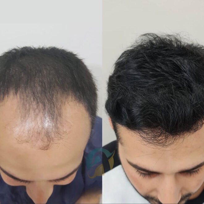 Hair Transplant in Islamabad: Restore Your Hair and Confidence