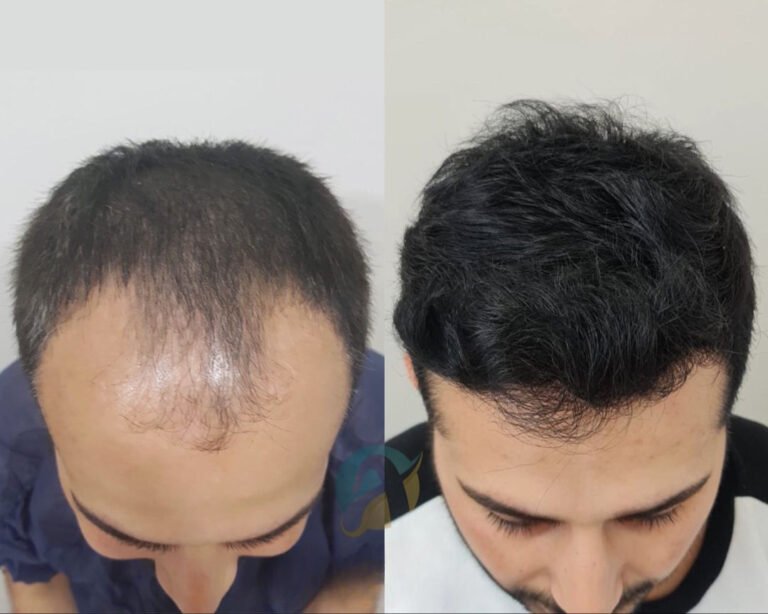Hair Transplant in Islamabad: Restore Your Hair and Confidence