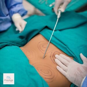 Liposuction in Islamabad – Redefine Your Body with Expert Care