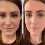 Best Doctors in Dubai Transforming Hair Growth with PRP Treatment