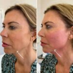 Endolift in dubai Transforming Facial Contouring Techniques