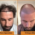 Best Hair Transplant Turkey: How to Deal with Post-Operative Redness