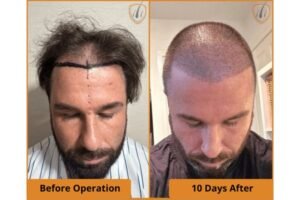 Best Hair Transplant Turkey: How to Deal with Post-Operative Redness