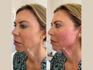Best Plastic Surgeon in dubai for Collagen Boosting Endolift Treatments
