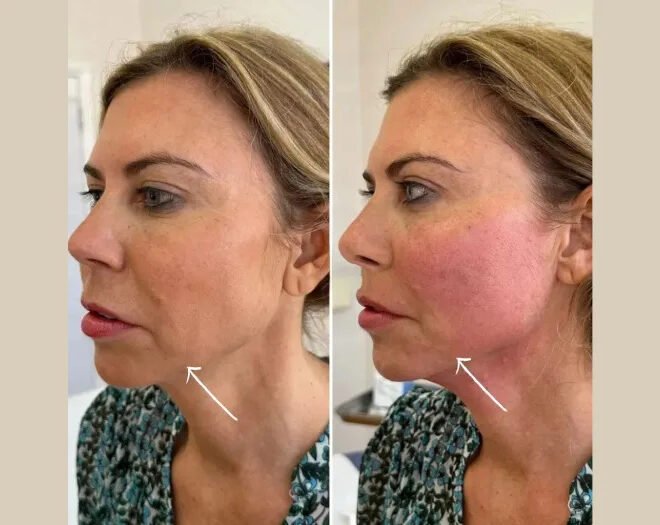 Best Plastic Surgeon in dubai for Collagen Boosting Endolift Treatments