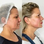 Best Doctors in dubai for Jawline Definition Using Endolift