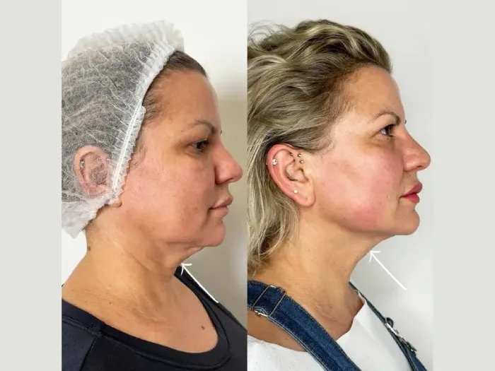 Best Doctors in dubai for Jawline Definition Using Endolift