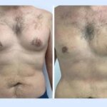Gynecomastia in Dubai: Common Questions About Surgery, Recovery and Long-Term Success