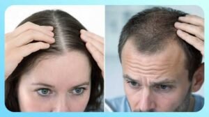 Why does Hair Loss Happen? Exploring Genetics, Hormones, and Lifestyle Factors