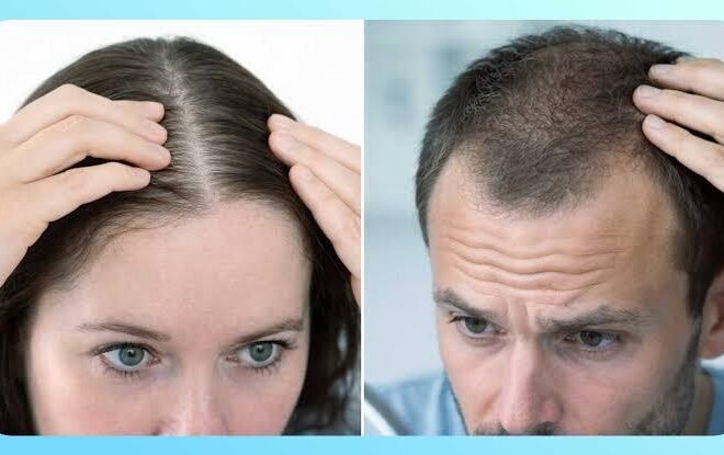 Why does Hair Loss Happen? Exploring Genetics, Hormones, and Lifestyle Factors