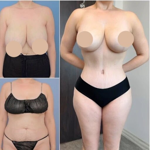 Advanced Body Contouring by the Best Tummy Tuck Surgeon in Dubai
