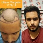 Hair Transplant in Gurgaon: Complete Guide to Treatment, Cost and Recovery