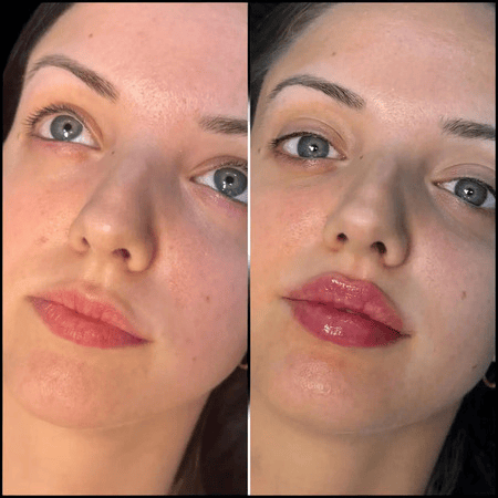 Fillers Treatment in Dubai: The Role of Technology in Modern Procedures