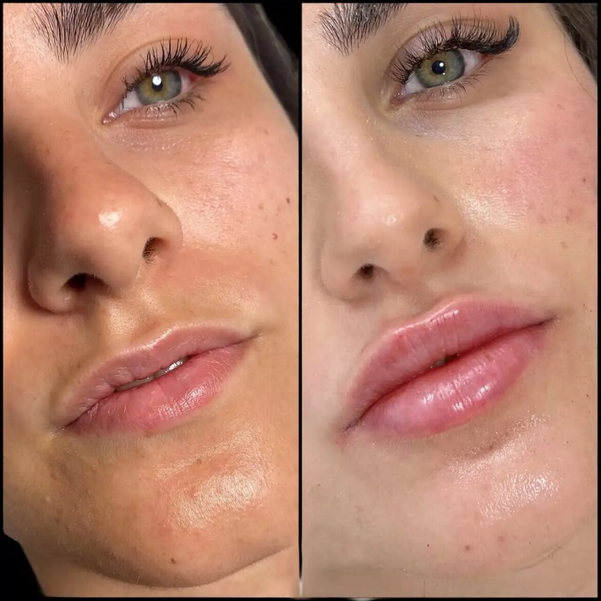 Fillers Treatments in Dubai for a Fresh and Confident Look