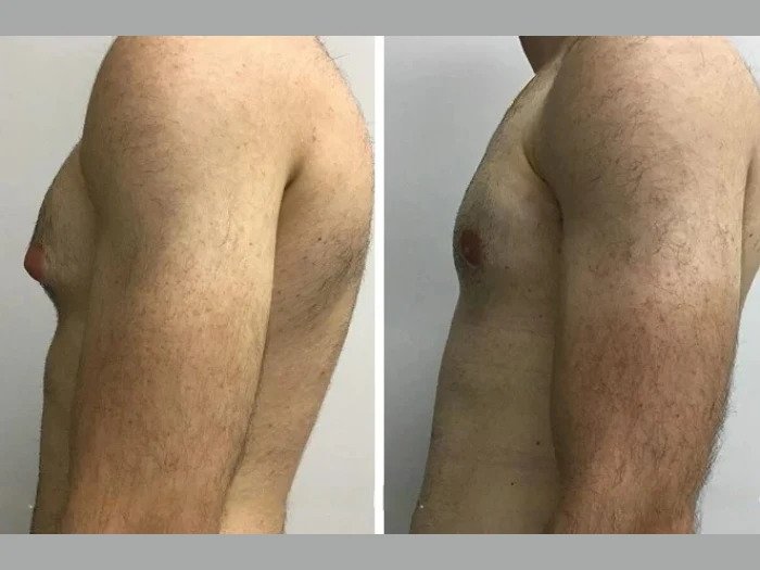 Best Doctors in Dubai for Gynecomastia: Precision Treatment