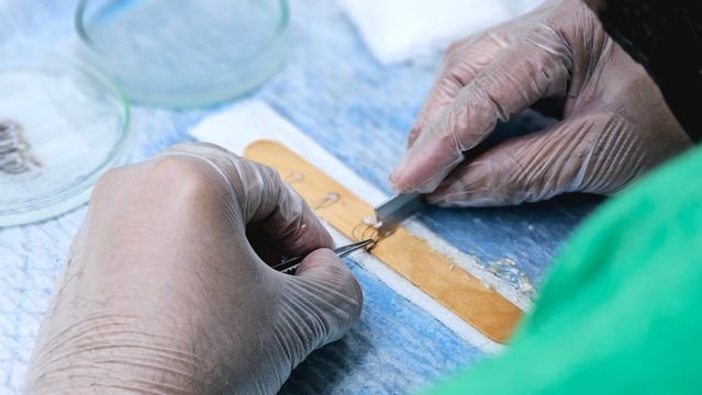 Understanding the Market for Amniotic Grafts and Amniotic Tissue Allograft Products