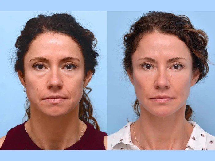 Best Plastic Surgeons in Dubai: Superior Facial Rejuvenation Through Thread Lift Procedures